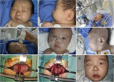 Modified mandible traction with wires to treat neonatal Pierre Robin sequence: A case report